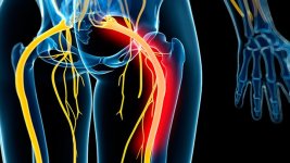 Sciatica-Symptoms-and-Diagnosis-722x406.jpg