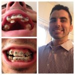 brace1.jpg brace1.jpg