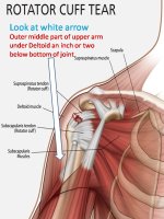 rotator-cuff-tear2.jpg