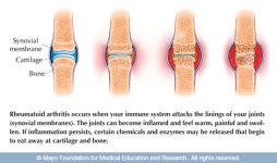Rheumatoid_large.jpg Rheumatoid_large.jpg