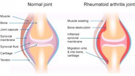rheumatoid-arthritis-diagram.jpg rheumatoid-arthritis-diagram.jpg