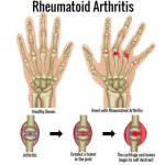 rheumatoid.jpg rheumatoid.jpg
