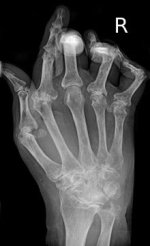 RheumatoideArthritisAP.jpg RheumatoideArthritisAP.jpg